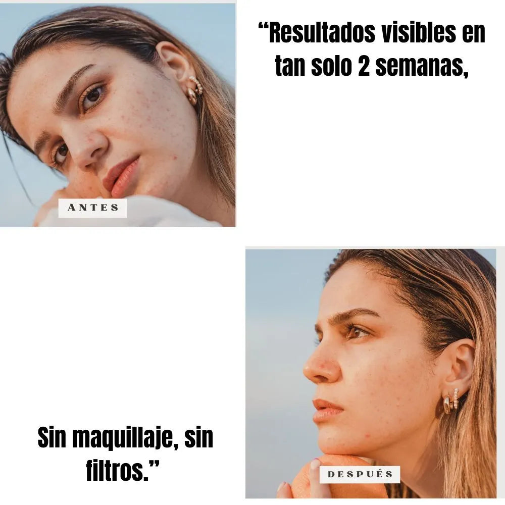 Ácido Kójico + Niacinamida Aclara manchas oscuras