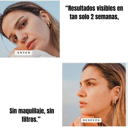 Ácido Kójico  + Niacinamida  Aclara manchas oscuras