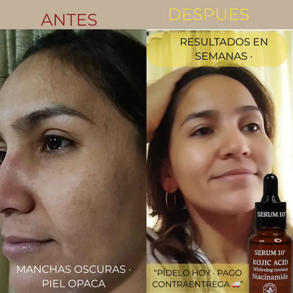Ácido Kójico  + Niacinamida  Aclara manchas oscuras